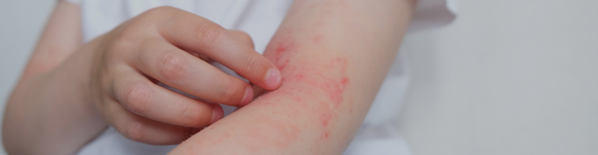 Expert Still's disease Treatment Solutions Compassionate Care at Medanta