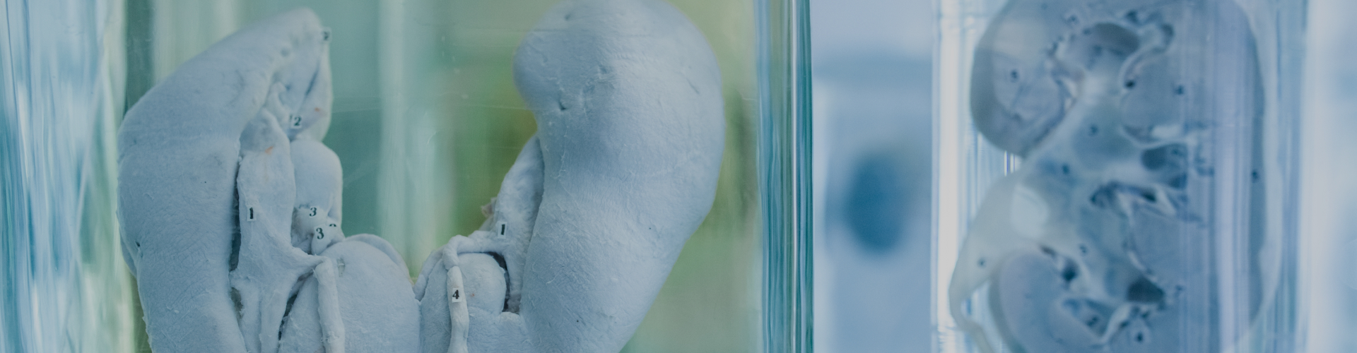 Horseshoe Kidney Symptoms, Causes, Risk, & Prevention