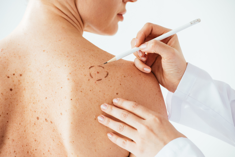 understanding-melanoma-symptoms-causes-and-treatment