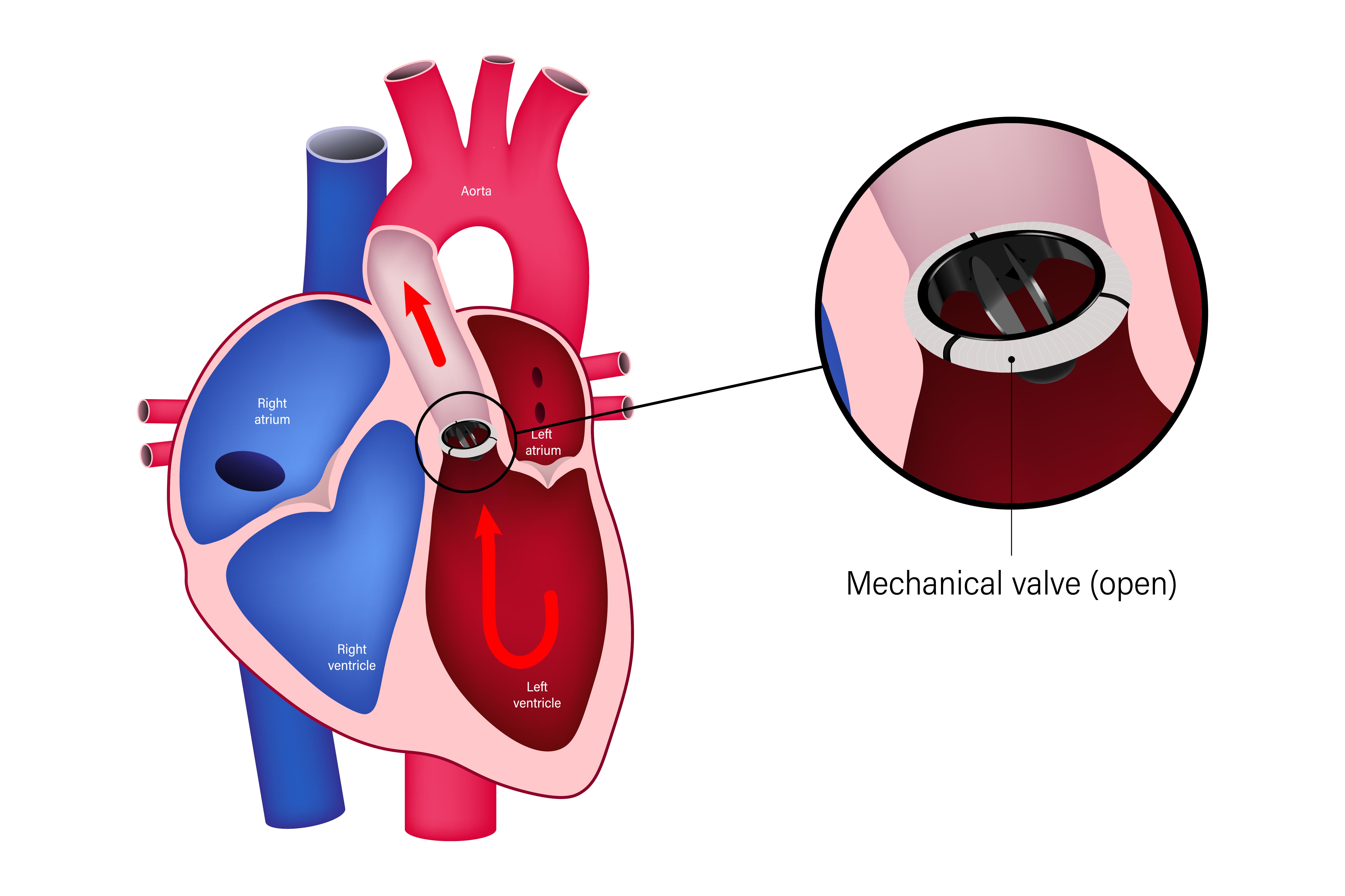 Heart Valve Replacement Surgery Procedure Benefits Recovery