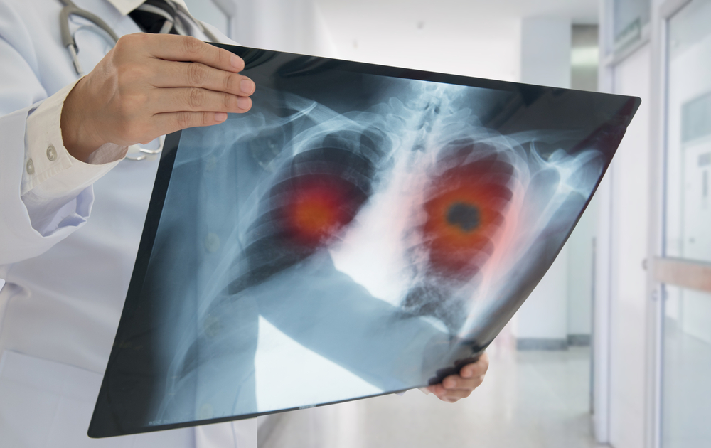 lung-cancer-symptoms